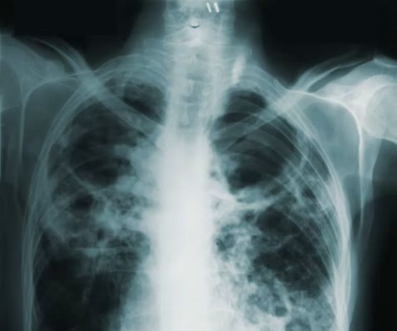 WHO: Tuberculosis claimed 1.2 million lives globally in 2024   